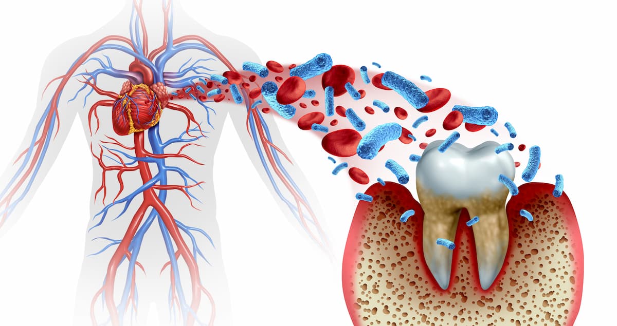 Illustration showing link between oral bacteria and heart health in Pittsburgh, PA Metro Area